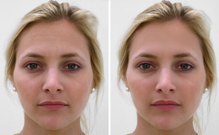 Собственный жир в лицо до и после фото