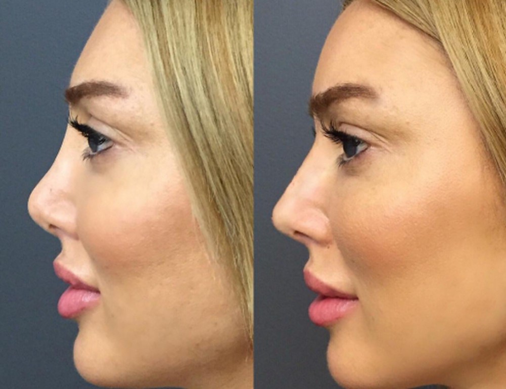 Фото: до и после повторной пластики носа