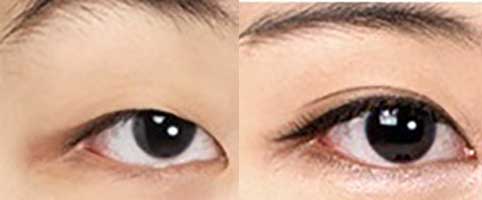 Пластика азиатских глаз