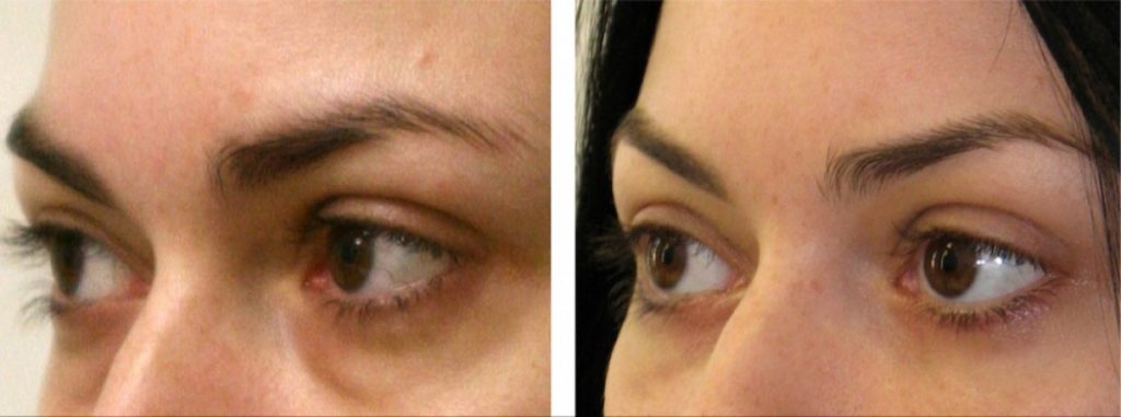Липофилинг носослезной борозды (фото до и после)