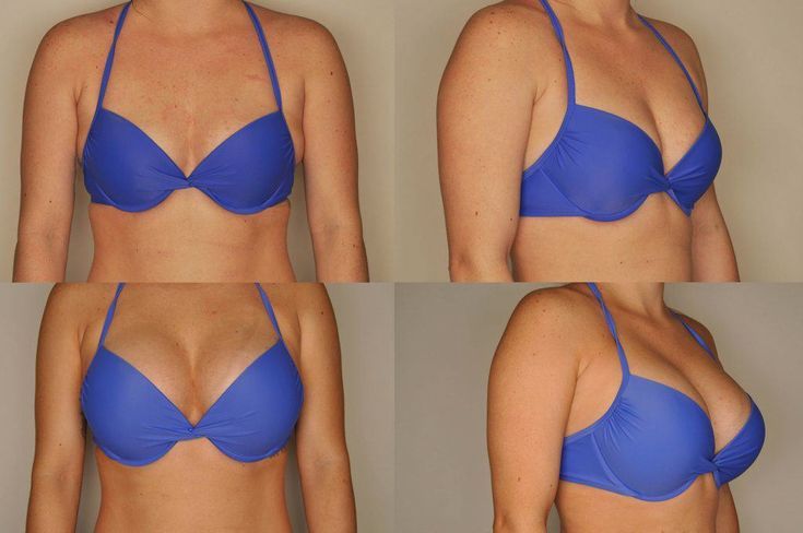 результаты до и после имплантантов груди