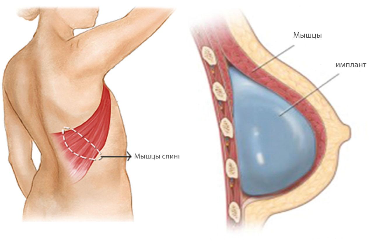 уплотнение в груди у женщин операция фото 46