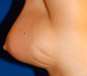 Контурирование имплантата груди на поверхности кожи