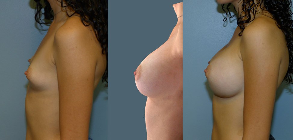 результаты до и после имплантантов груди