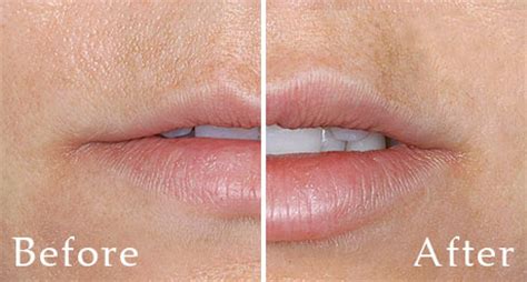 Фото до и после увеличения губ