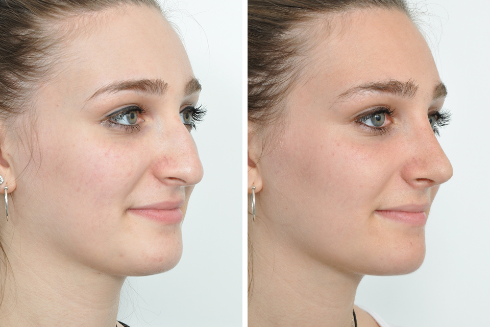 фото до и после ринопластики носа
