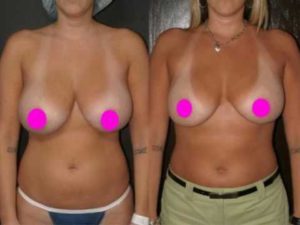 фото до и после уменьшения груди