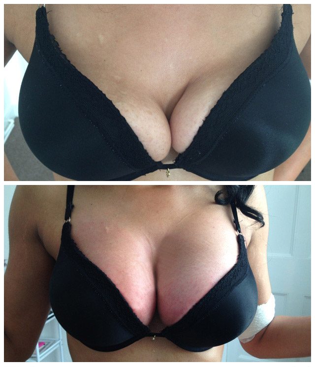фото до и после подтяжки груди